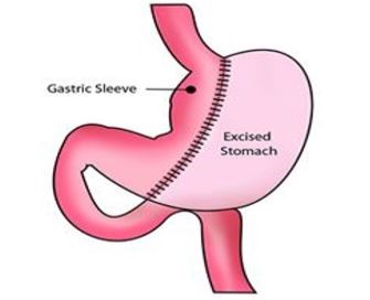 gastric sleeve diagram