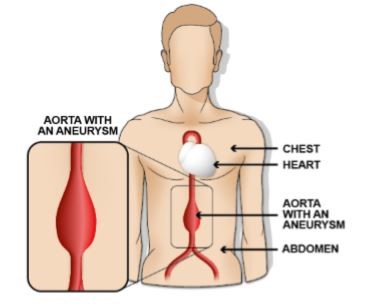 Aorta with an aneurysm diagram
