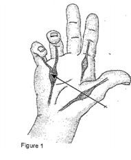 arrow pointing to disgram of contracted tissue causing ring and little finger to bend towards the palm