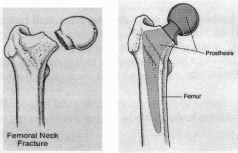 femoral neck fracture compared to replaced neck with prosthesis