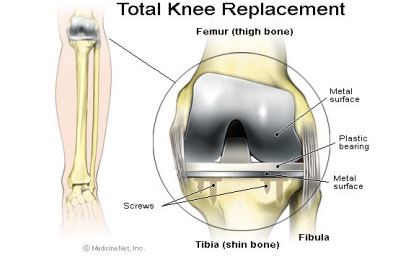 Knee replacement diagram