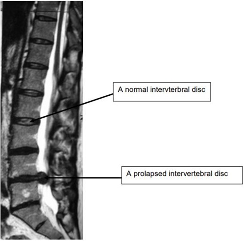 Spinal disc diagram- A normal interverbral disc and below,  A prolapsed intervertebral disc