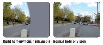 Right homonymous hemianopia (half of the visual covered) vs Normal field of vision